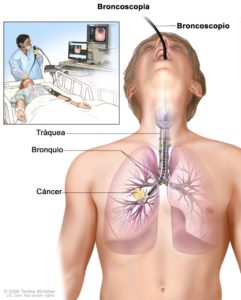 Evaluación de Vía Aerea - Fibrobroncoscopia