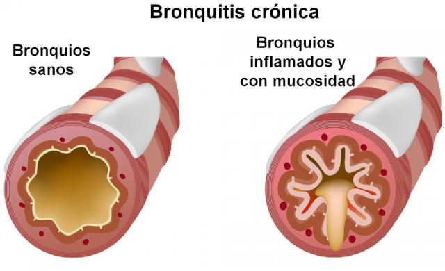 Bronquitis Crónica (EPOC)