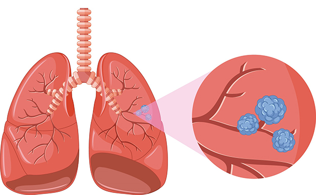 Cancer Pulmonar