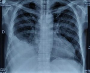 derrame pleural