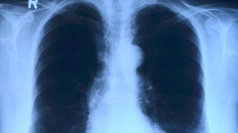 Lee más sobre el artículo Derrame pleural